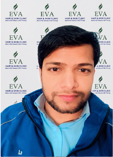After hair transplant result 10